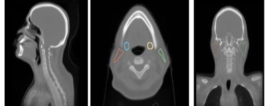 Deep learning xerostomia prediction model with anatomy normalization and high-resolution class activation map's image showing a brief idea of what this post is about.
